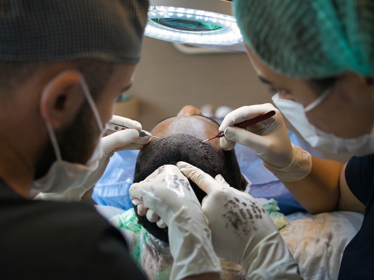 To get a younger look from hair transplant, then know these essential issues earlier than remedy