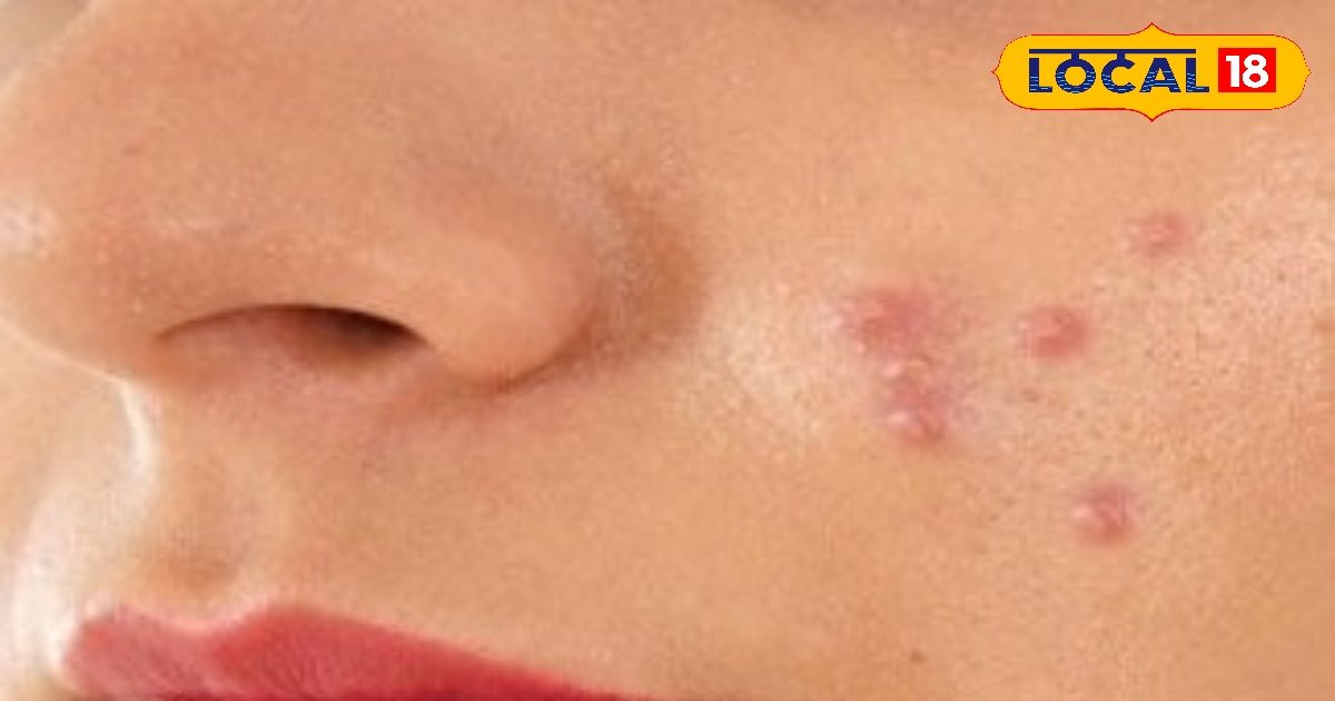 सेहत – फेस पर दो दिन पहले पिंपल्स निकालें तो क्या करें? 3 आसान तरीके से तुरंत संभव आराम सेहत – फेस पर दो दिन पहले पिंपल्स निकालें तो क्या करें? 3 आसान तरीके से तुरंत संभव आराम