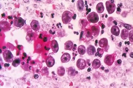 Brain Eating Amoeba: কোৰোণা আছেই এইবাৰ USত ভয়াৱহ গতিত বিয়পিছে মগজু খোৱা এমিবা, বিজ্ঞানীৰ সকীয়নি Brain Eating Amoeba: কোৰোণা আছেই এইবাৰ USত ভয়াৱহ গতিত বিয়পিছে মগজু খোৱা এমিবা, বিজ্ঞানীৰ সকীয়নি
