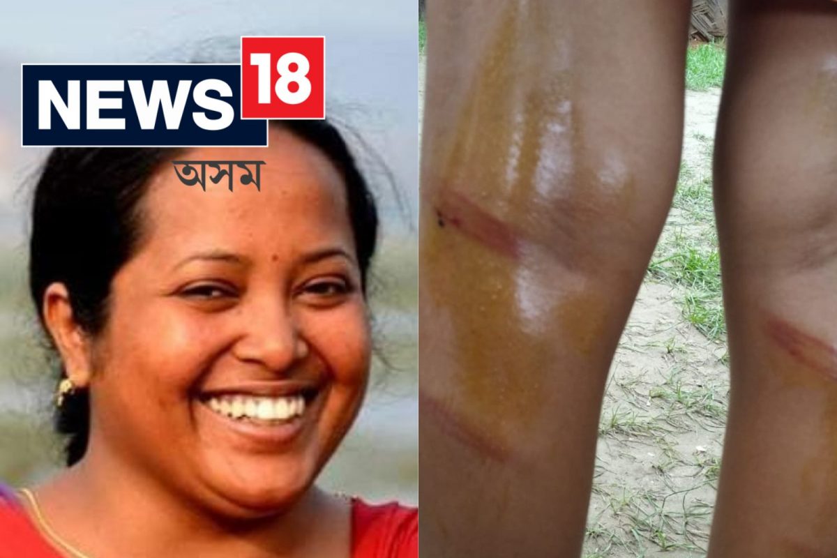 শিক্ষয়িত্ৰীৰ বেত্ৰাঘাতত চিৰিলা-চিৰিল এটি সাত বছৰীয়া শিশুৰ শৰীৰ