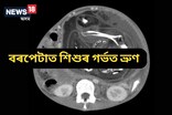 বৰপেটাত ৫মহীয়া সন্তানৰ পেটত ভ্ৰুণ, চিকিৎসকে জনালে এই বিৰল ঘটনাৰ কাৰণ