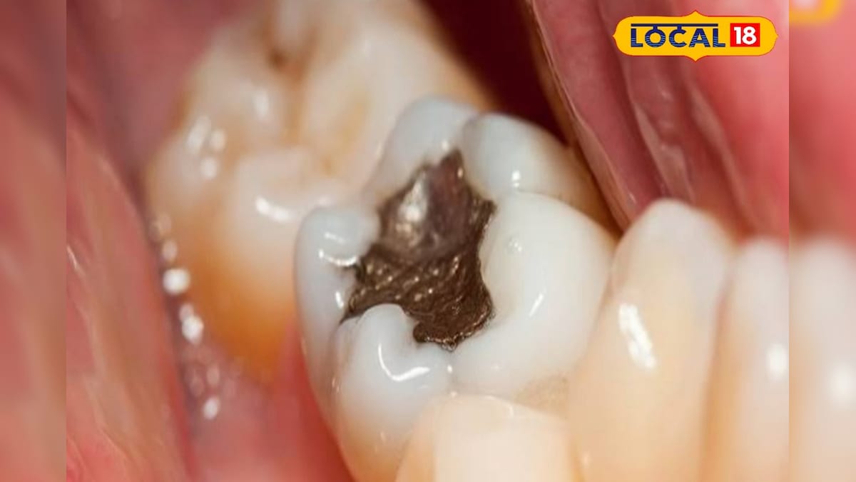 teeth problems and solutions | দাঁতত সঁচাকৈ পোক থাকে নেকি? দাঁতত বিষৰ ...