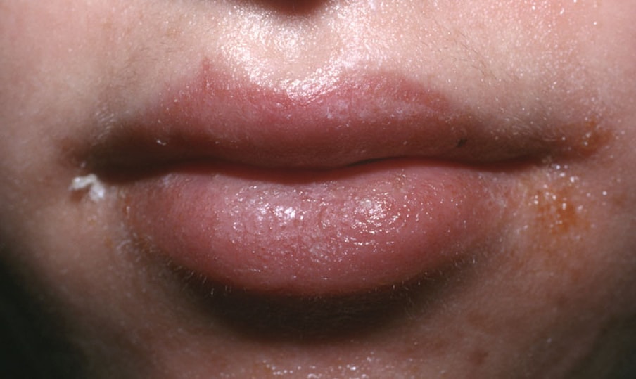 Allergic Reaction On Lips From Mango