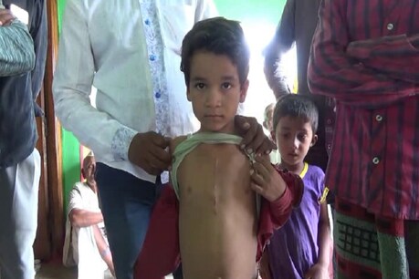 खदान के धमाके से इस बच्चे के दिल की बिगड़ी हालत तो करानी पड़ी हार्ट सर्जरी