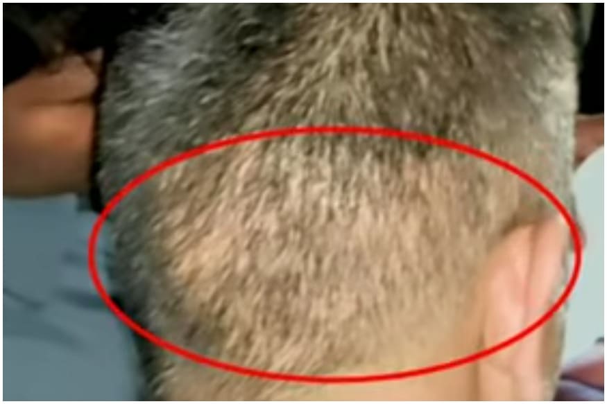 10 Cricketers who went for a hair transplant  My Site