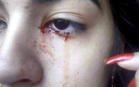 इस लड़की की आंखों से आंसू की जगह खून निकलता है. डॉक्टर्स भी इसकी वजह नहीं बता सके. (Photo- Facebook)