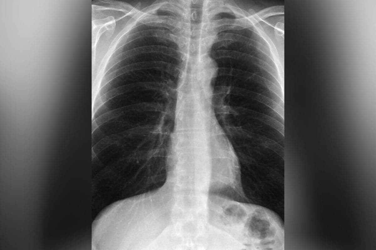 lungs