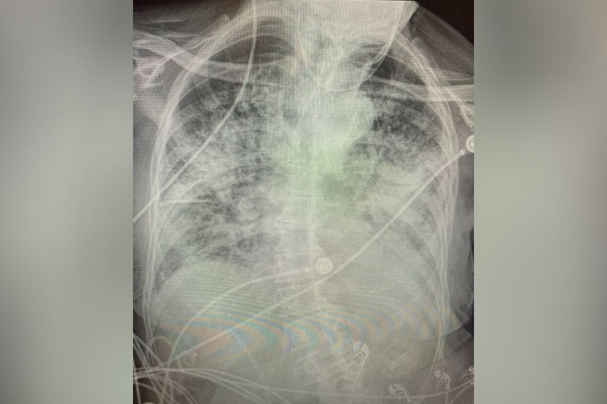 lungs