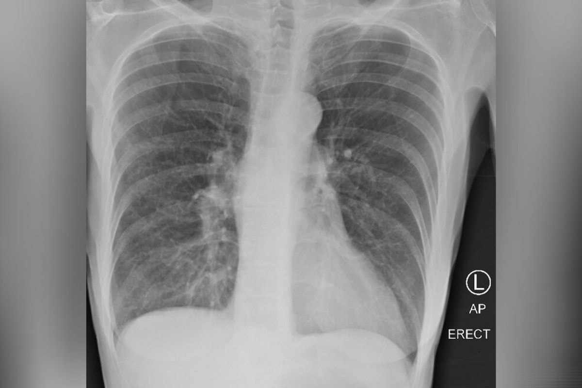 lungs