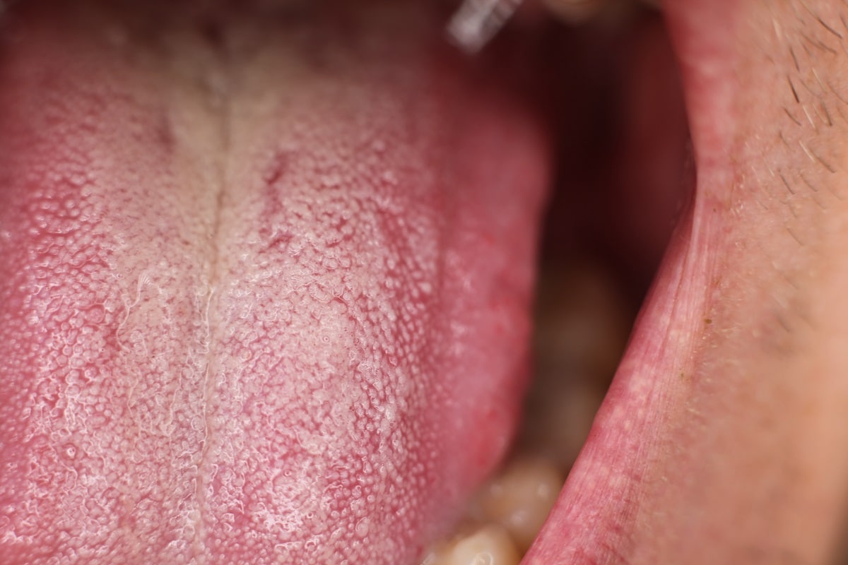 Health, Coronavirus, Covid-19, Covid Tongue, Corona infection, SARS CoV-2, ACE 2, Corona Symptoms, Tongue,