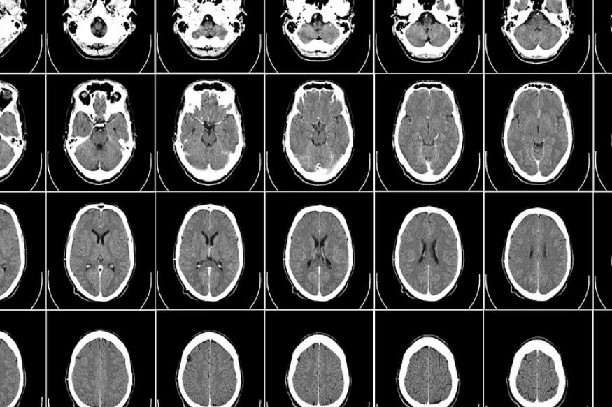 fearless rare brain disease