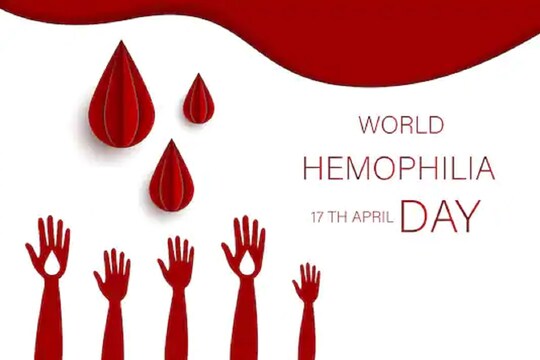 World Hemophilia Day 2021: विश्व हीमोफीलिया दिवस आज, जानें क्‍यों मनाते हैं  और क्‍या है इस बार की थीम – News18 हिंदी