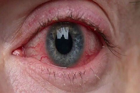कोरोना वायरस हमारी आंखो में रेडनेस एवं उनमें सूजन पैदा कर रहा है. (फाइल फोटो)