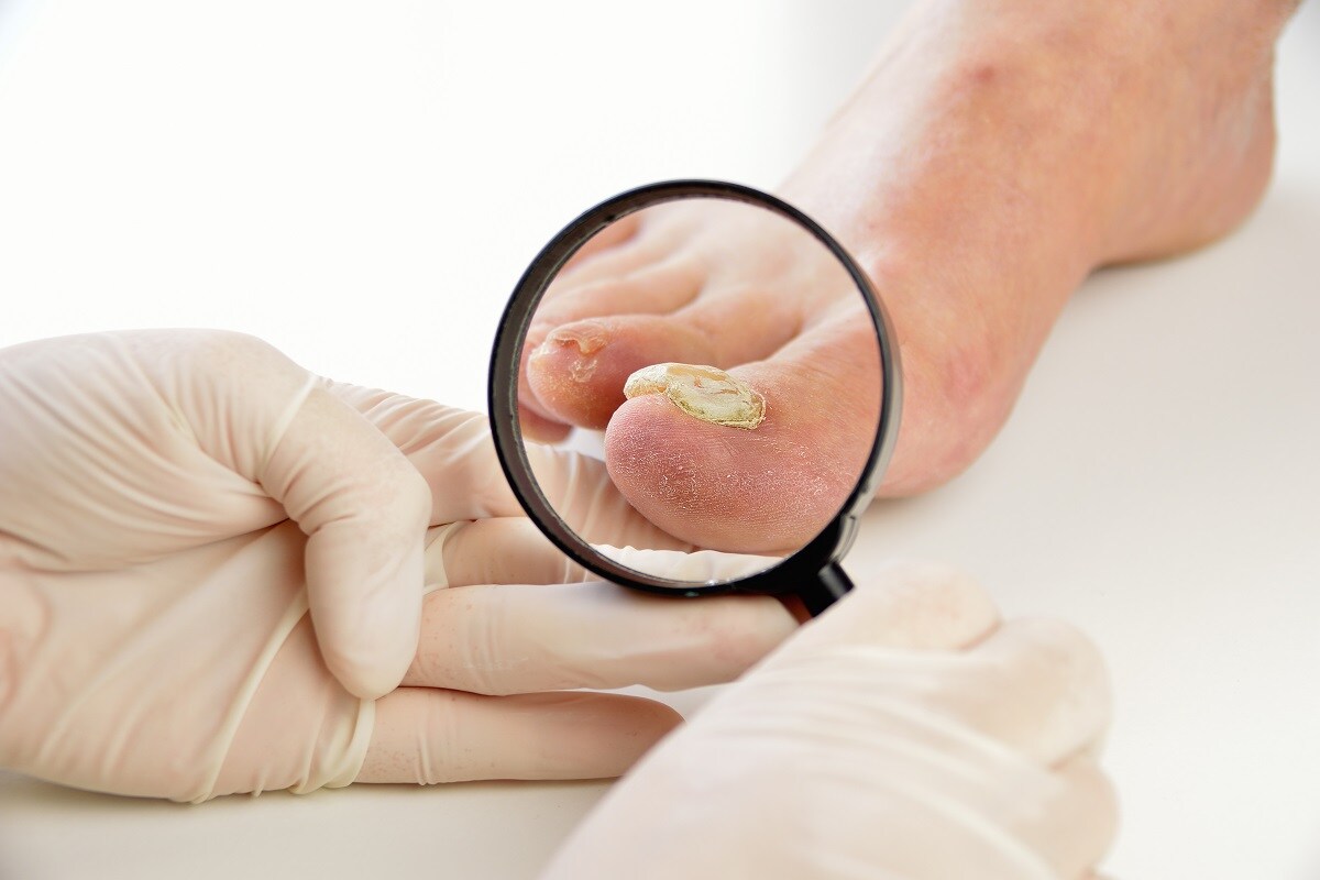 Research, Health, Fungus, Human body, Fungi, Black Fungus, Head, Foot, Genera of Fungus,