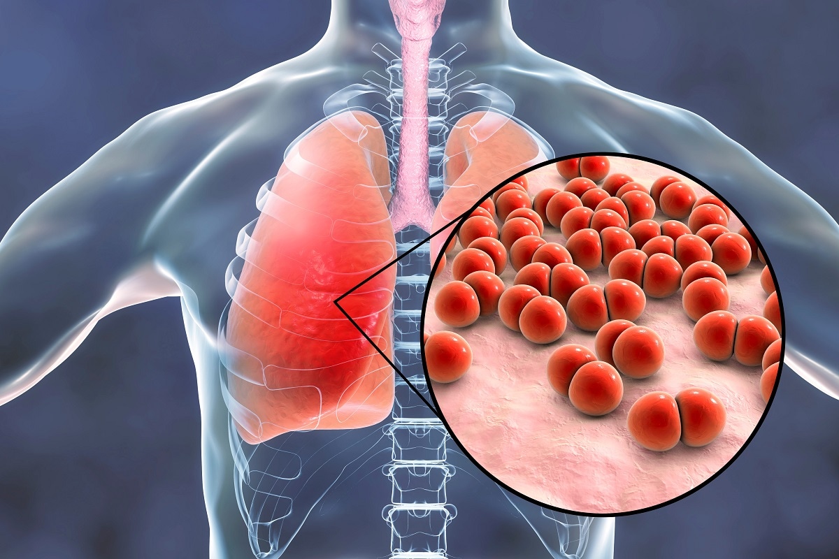 Health, Corona virus, Covid-19, Pneumonia, Lungs, Corona infection, Covid Pneumonia, Lungs,