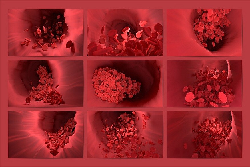 blood clotting post covid