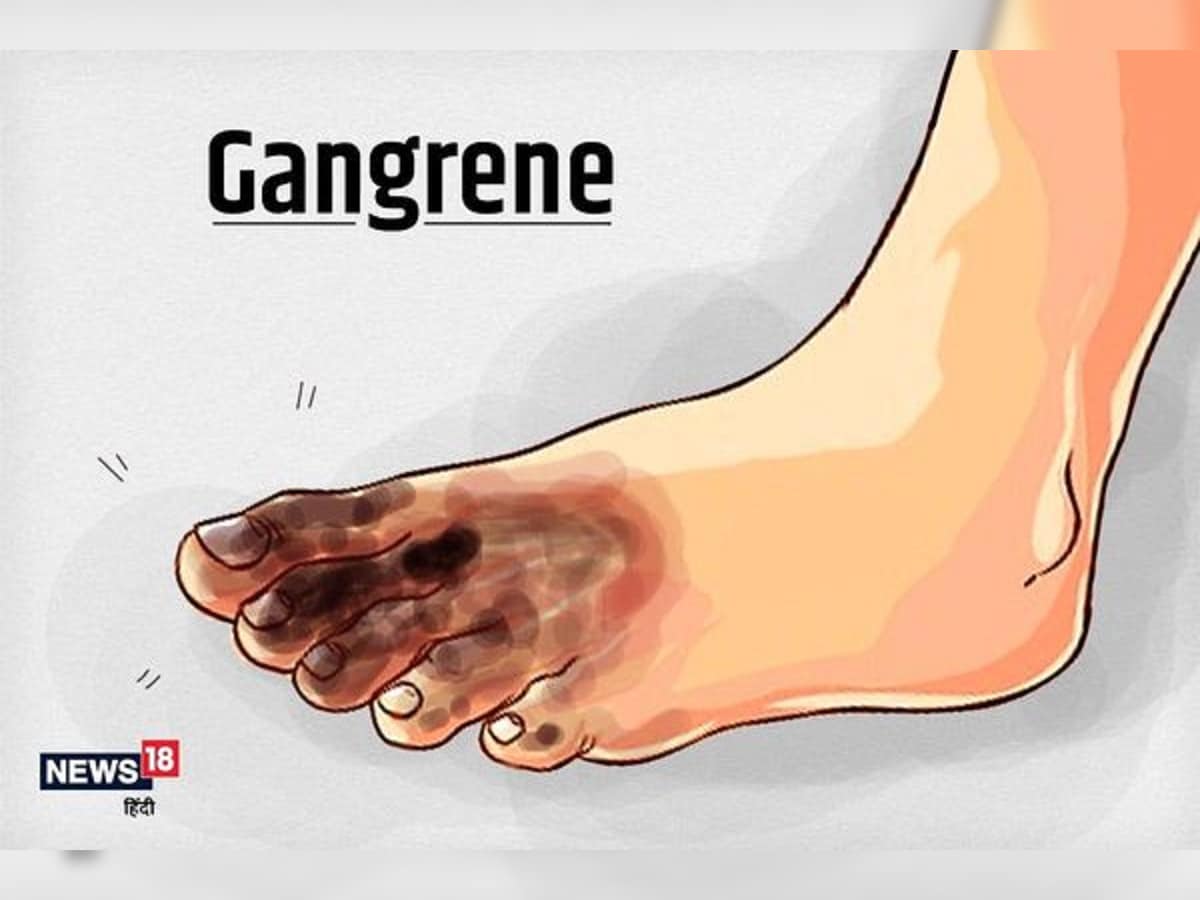 गैंगरीन हुआ तो खो सकते हैं अपना हाथ या पैर, शुगर पेशेंट और स्मोकर्स को है  ज्यादा खतरा – News18 हिंदी