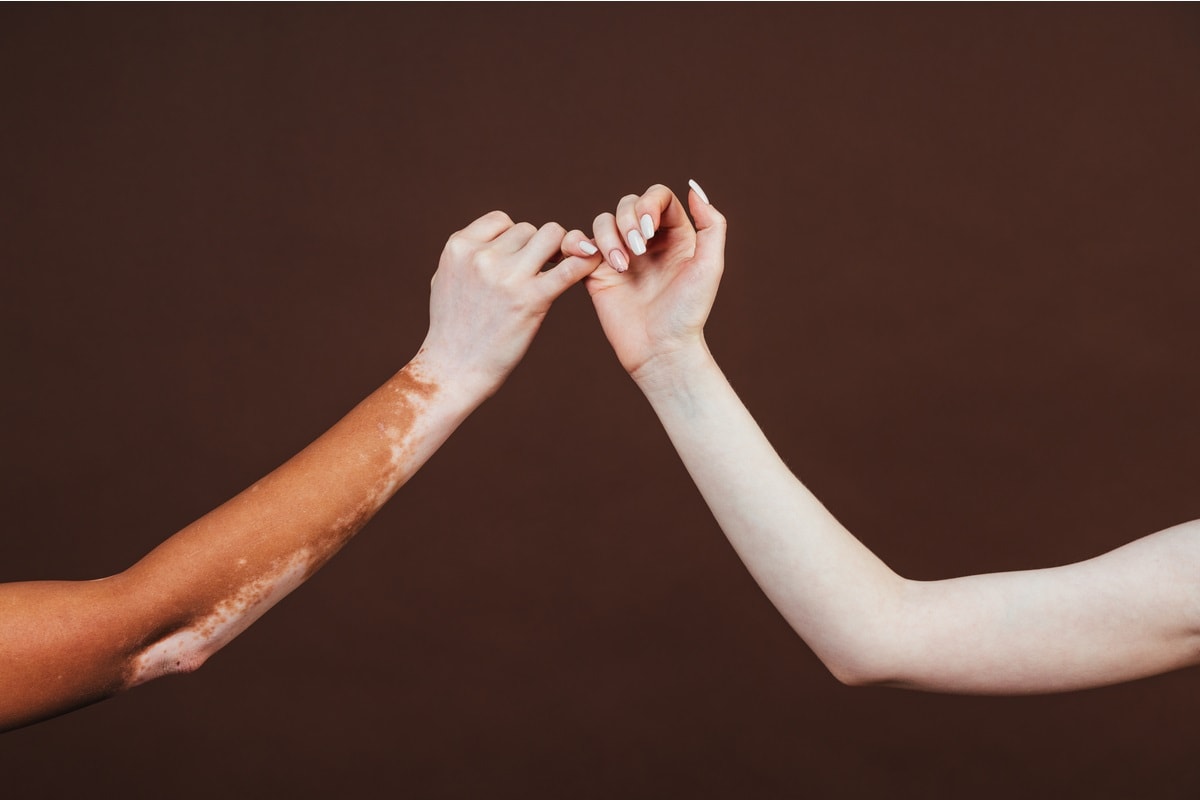 International Albinism Awareness Day 2021, Albinism, United Nations, theme, Strength beyond All Odds,