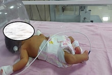 हरदा जिला अस्पताल में असामान्य बच्ची का जन्म : दोनों पैर उल्टे और पंजे पीठ की तरफ