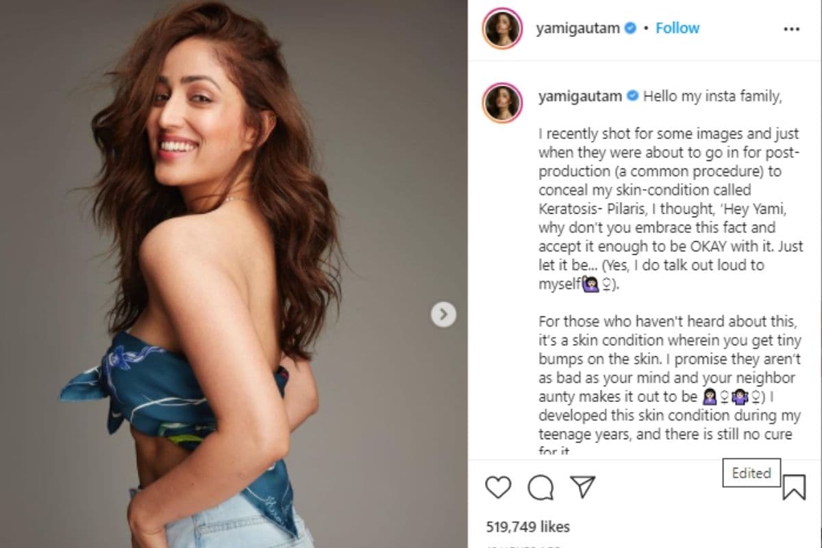 yami gautam, yami gautam skin problem