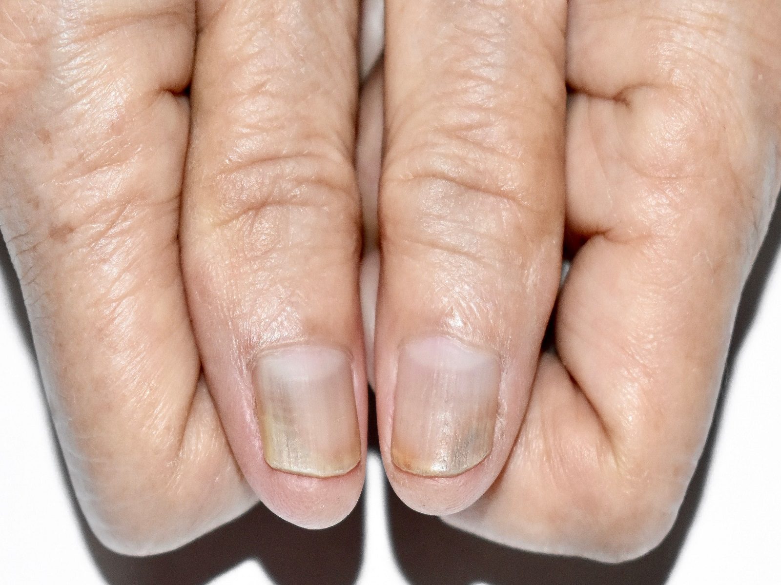 नखांना बुरशीचा संसर्ग झाल्यास काय कराल? - Marathi News | What to do if the  fingernails are infected with fungus? | Latest health News at Lokmat.com