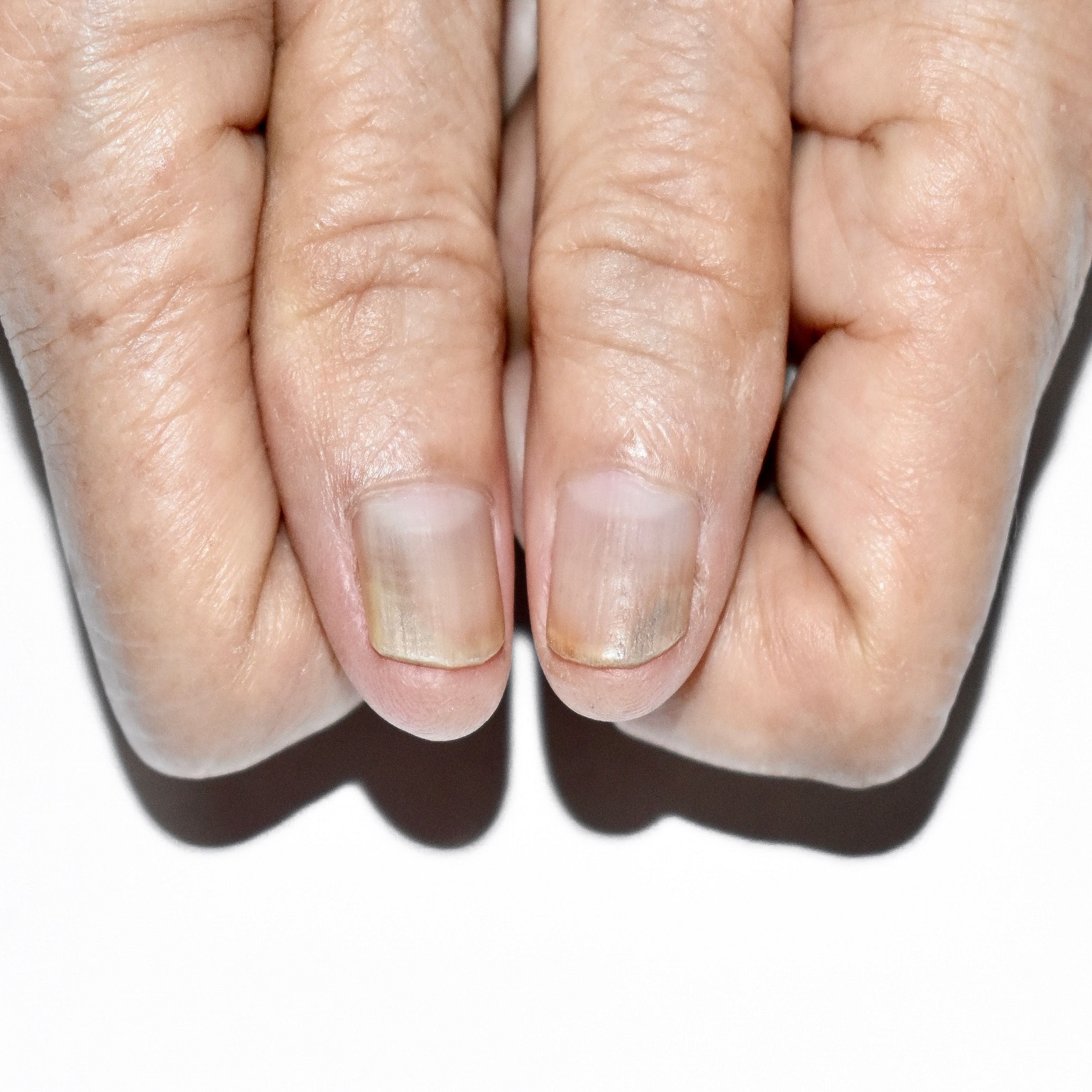 10 High Cholesterol Warning Symptoms in Fingers and Toes