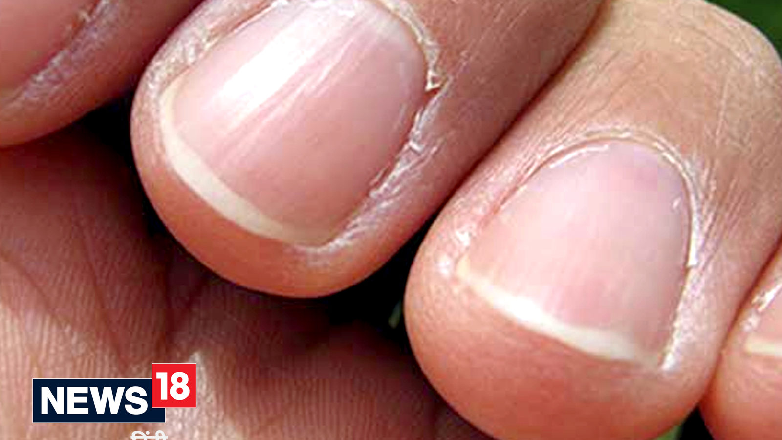 Know how to keep your nails healthy and strong.- जानिए अपने नाखूनों को  सुंदर और मजबूत बनाने के 8 टिप्स। | HealthShots Hindi