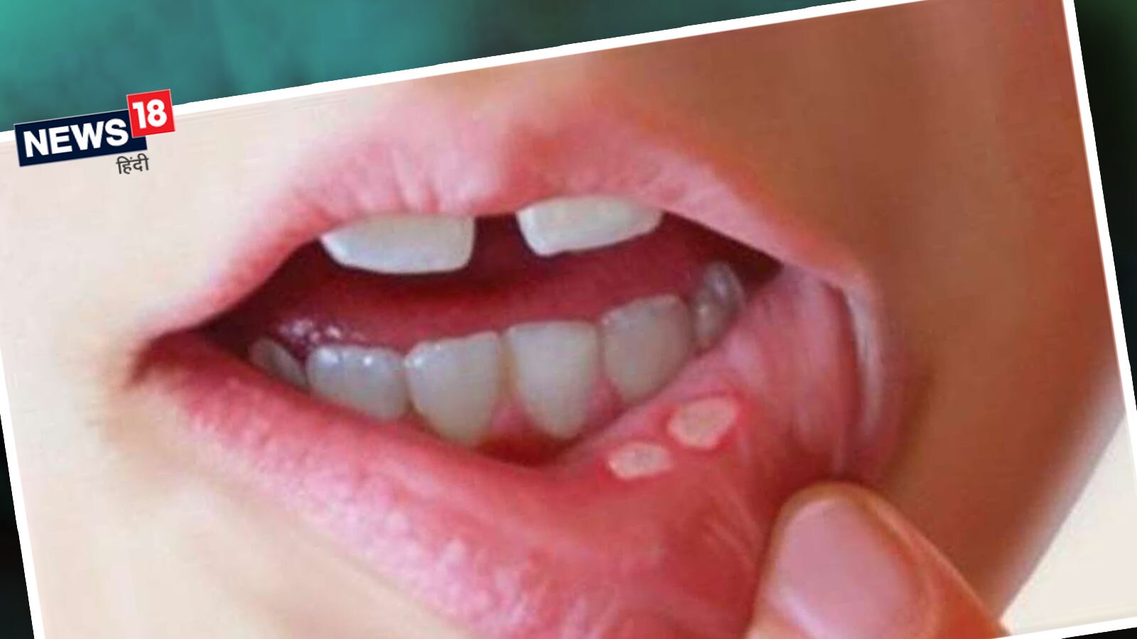 Tips to Get Rid of Mouth Ulcer: मुंह के छालों से छुटकारा दिलाने में ये