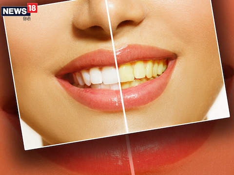 दांतों में पीलेपन के कई कारण होते हैं.