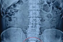OMG: मरीज के पेट से निकला शीशे का गिलास, ऑपरेशन के दौरान डॉक्टरों के छूटे पसीने