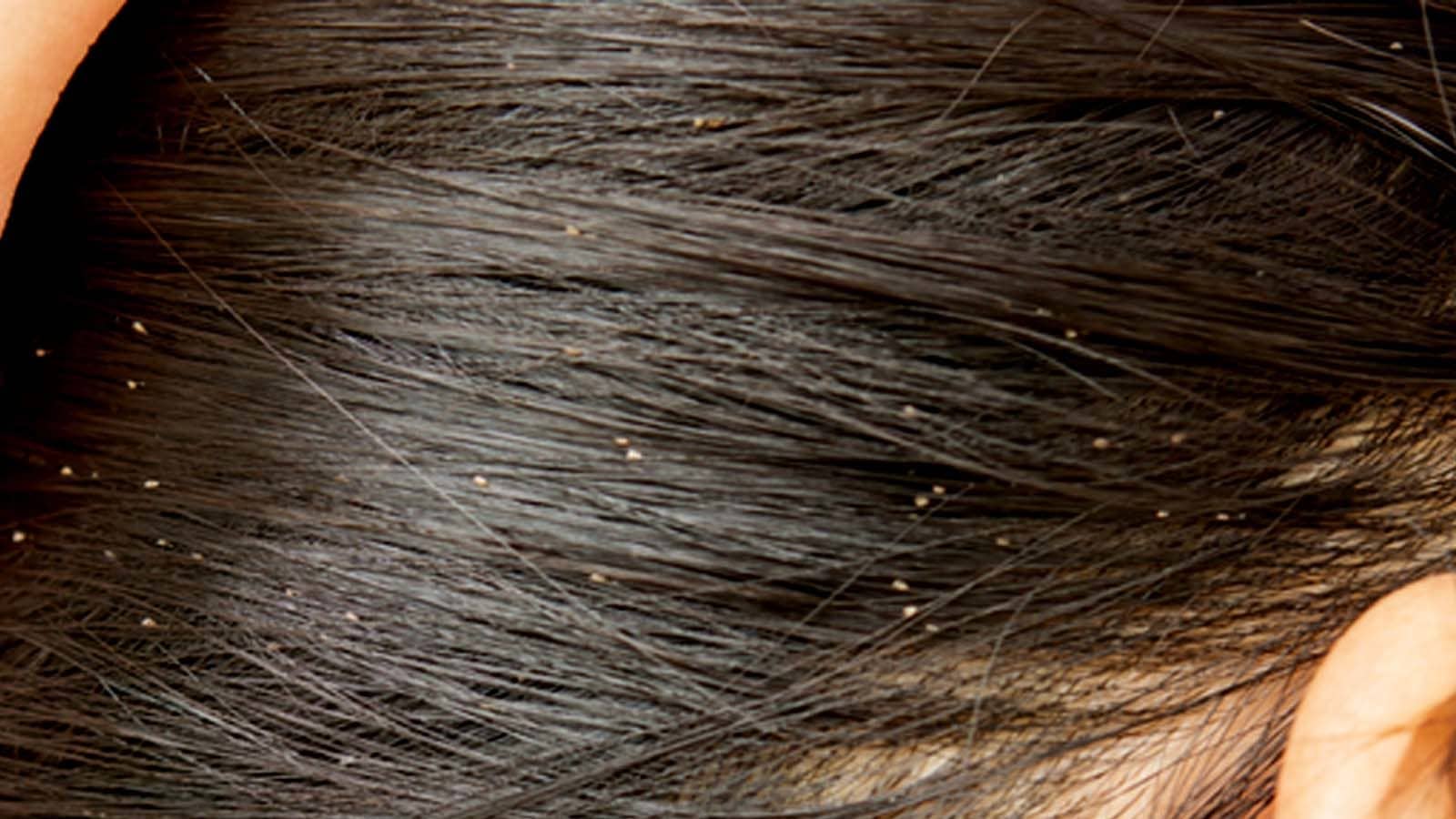 Hair lice removal hires stock photography and images  Alamy