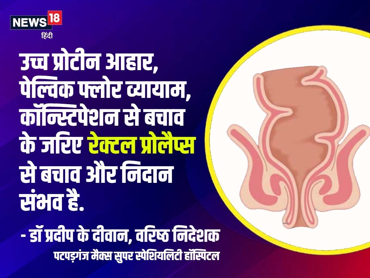 Health Tips: महिलाओं में आम होती रेक्‍टल प्रोलैप्‍स बीमारी के लक्षण, कारण और इलाज | Health news rectal prolapse Symptoms causes treatment common disease women sehat ki baat nodakm | हेल्‍थ टिप्‍स, रेक्टल प्रोलैप्स बीमारी, रेक्टल प्रोलैप्स के लक्षण, रेक्टल प्रोलैप्स के कारण, रेक्टल प्रोलैप्स का उपचार, महिलाओं में सामान्य रोग, Health Tips, rectal prolapse disease, Symptoms of rectal prolapse, causes of rectal prolapse, treatment of rectal prolapse, common disease in women,