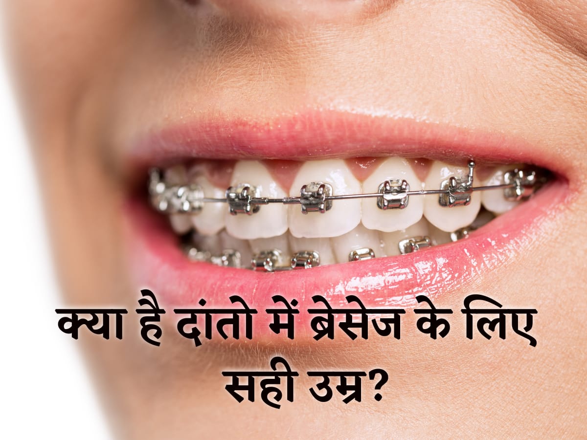 दांतों में ब्रेसेज के लिए क्या है सही उम्र? यहां जानिए, किसे लगवाने