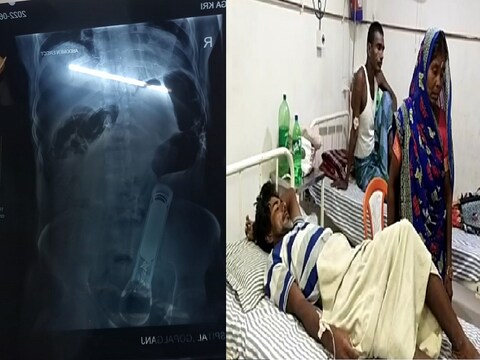 गोपालगंज में एक शख्स के प्राइवेट पार्ट में टॉर्च डाल दिया गया.