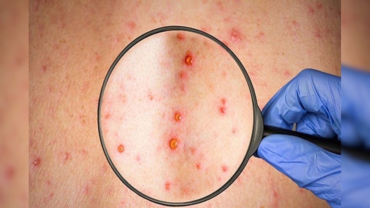 कैसे फैलता है मंकीपाक्स वायरस का संक्रमण कितना है खतरनाक और क्‍या है इलाज जानें लक्षण और बचाव