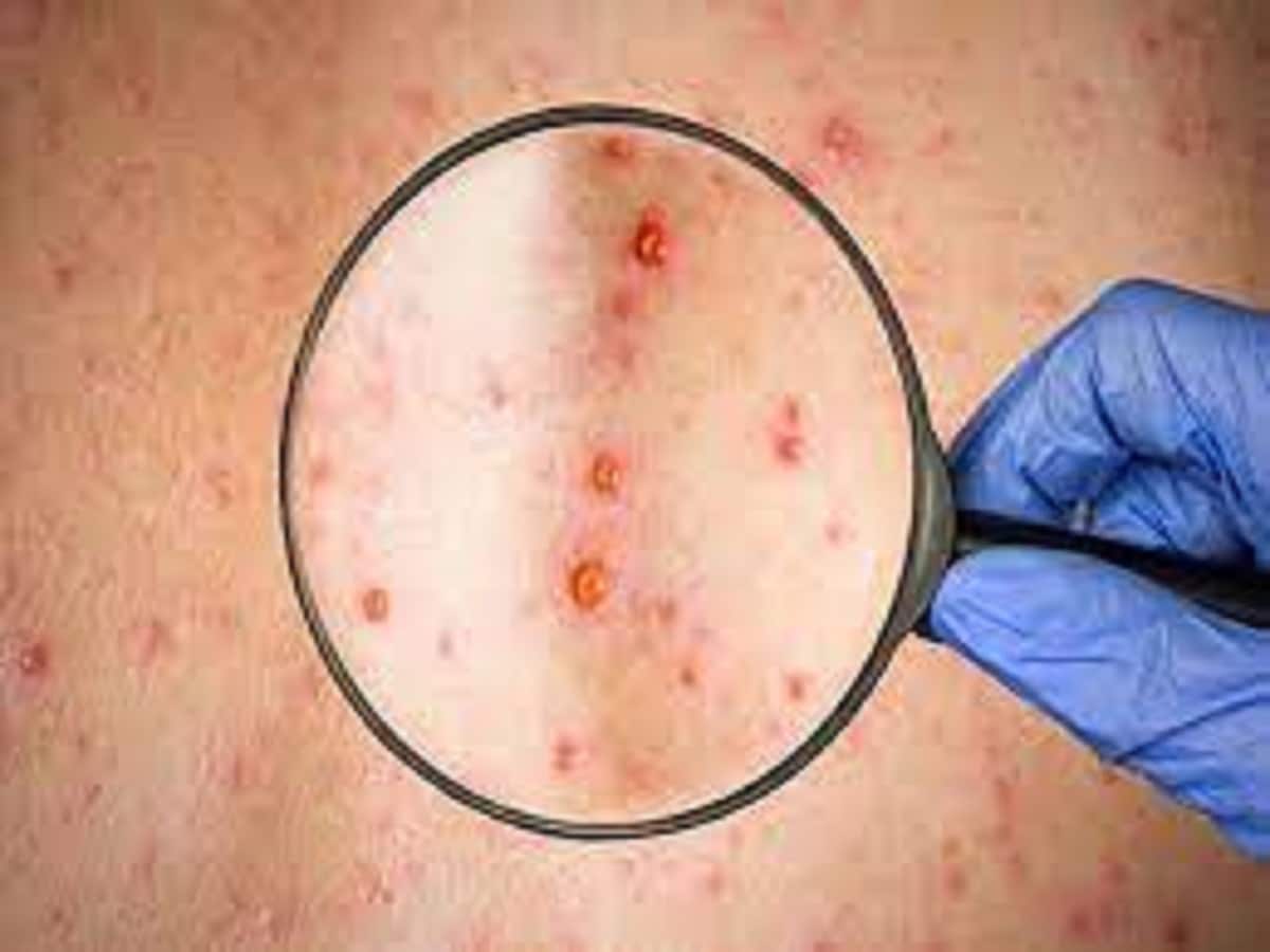 Symptomps of Monkey pox virus