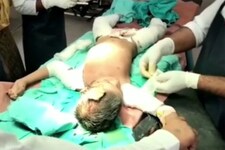 आगरा: आदमखोर कुत्तों ने मूक-बधिर बच्ची को 36 बार नोचा, इलाज के दौरान हुई मौत