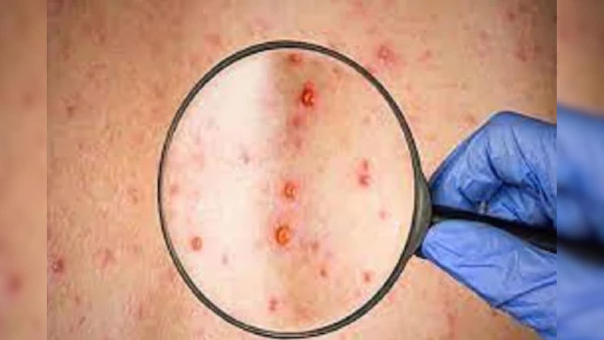 Monkeypox News: मंकीपॉक्स को लेकर यूपी बिहार सहित कई राज्यों में अलर्ट जारी इन लक्षणों को न करें नजरअंदाज