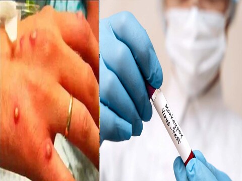 मंकीपॉक्स के बढ़ते मामलों पर अलर्ट: गाइडलाइन जारी. (सांकेतिक फोटो)