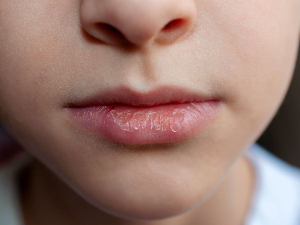 आपके भी होंठ अक्सर कटे-फटे रहते हैं, Image-Canva
