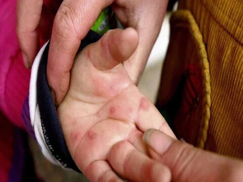 उत्तर प्रदेश की राजधानी लखनऊ में 12 बच्चो में टोमेटो फ्लू जैसे लक्षण देखने को मिले हैं (सांकेतिक तस्वीर)