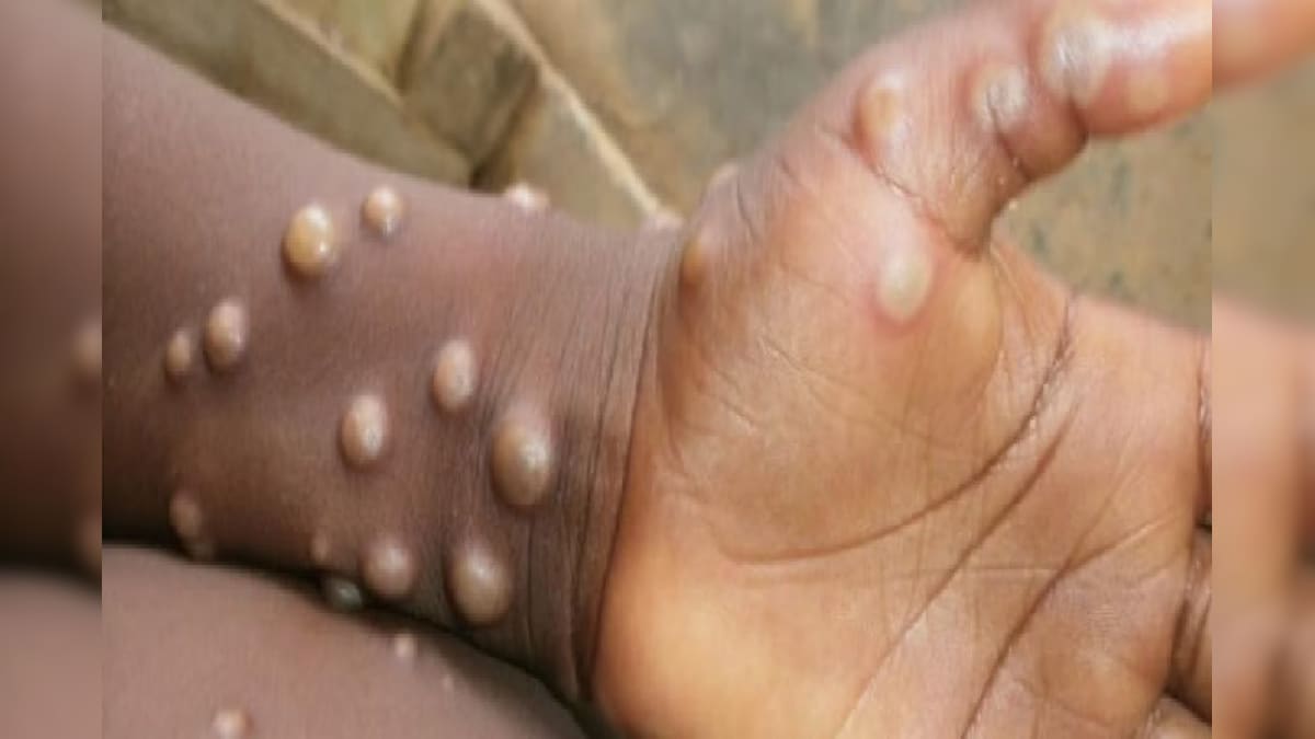 दिल्ली में मिला मंकीपॉक्स से संक्रमित नाइजीरियन युवक भारत में मरीजों की संख्या हुई 19