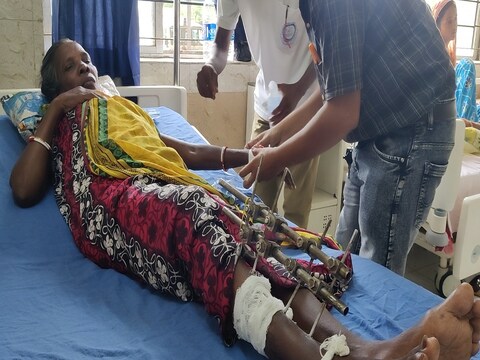 पीड़ित महिला 11 माह से पैर में लगे रॉड को निकालने का इंतजार करती रही. 
