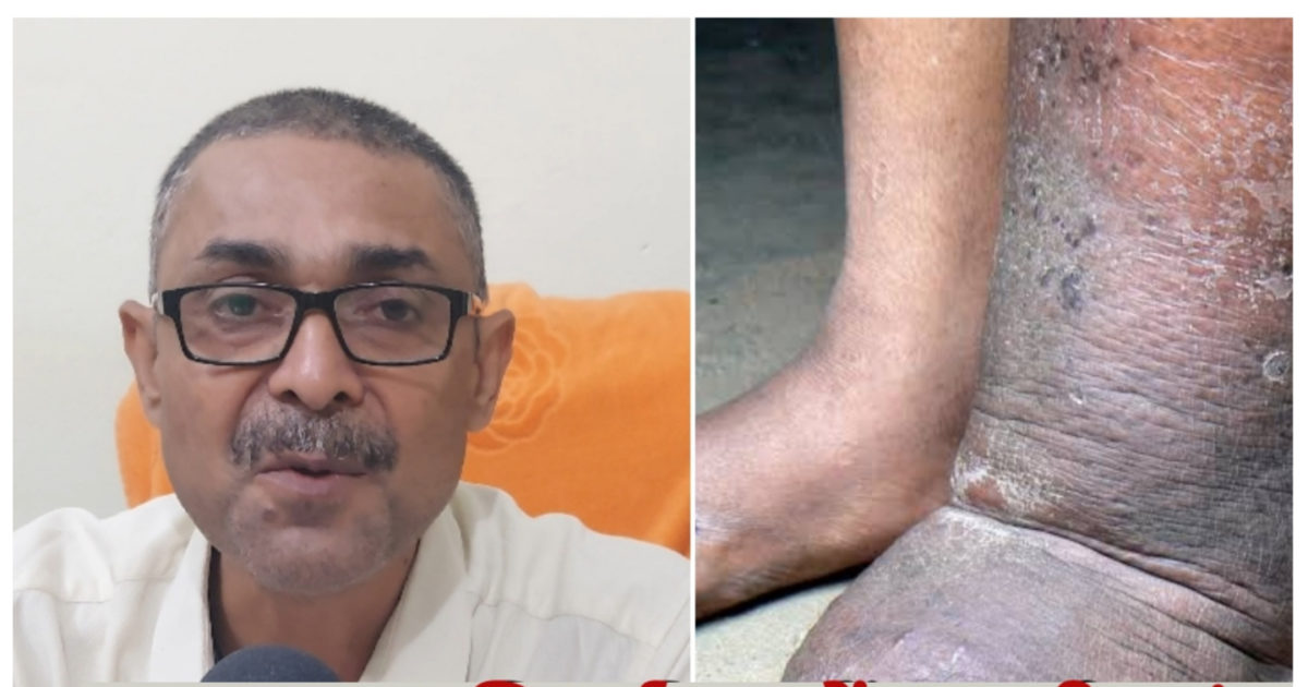 trending-news-attention-knock-of-elephant-foot-disease-in-mirzapur