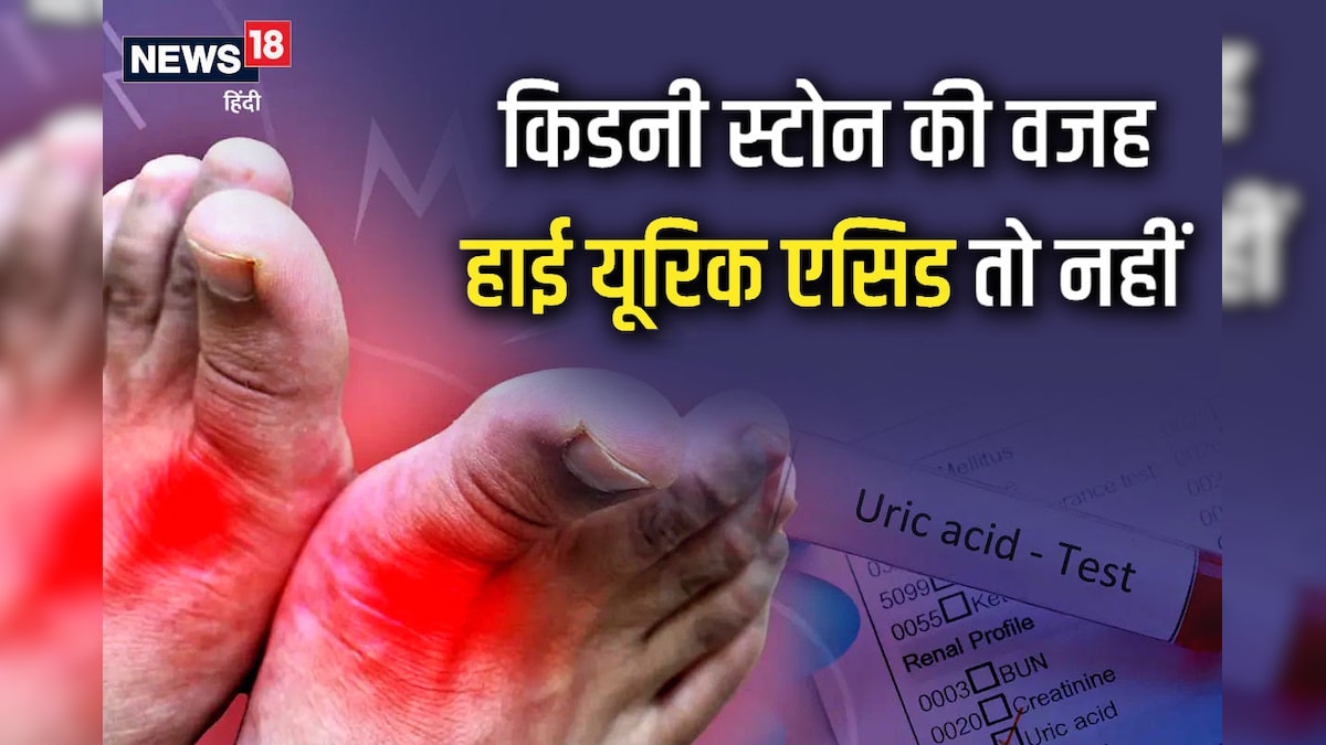 Uric Acid बढ़ने से हो सकती है किडनी स्टोन की समस्या ! जानें इसे कंट्रोल करने का आसान तरीका