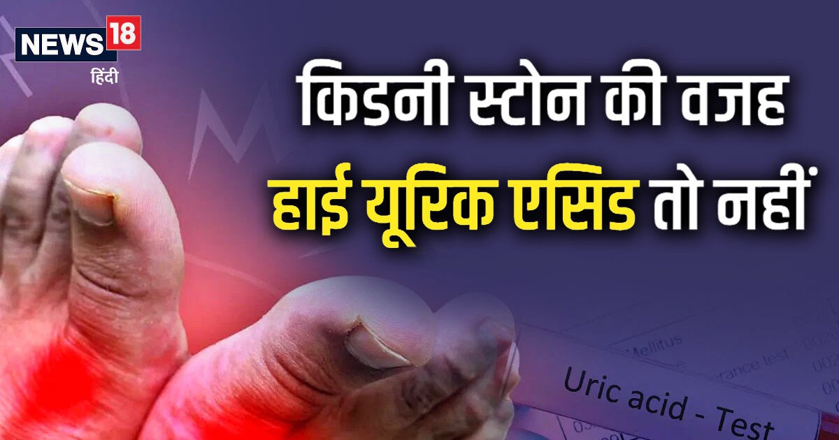 Uric Acid बढ़ने से हो सकती है किडनी स्टोन की समस्या ! जानें इसे कंट्रोल