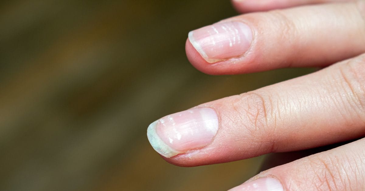 क्या आपके नाखून पर भी ये सफेद निशान हैं, इसका कैल्शियम की कमी से कोई  कनेक्शन नहीं है, जानिए इसकी वजह | Are white spots on your fingernails  really sign of calcium