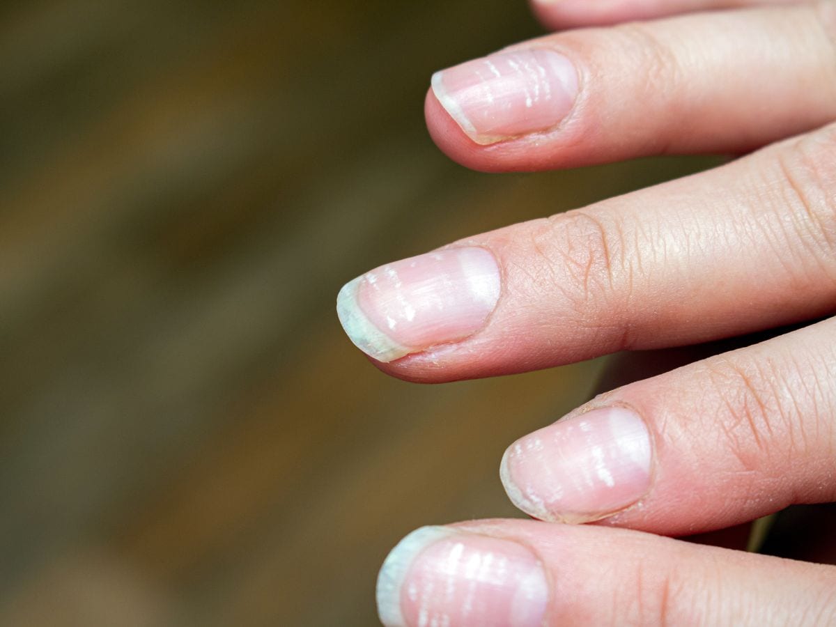 Yellow Nails: 6 Common Causes & What to Do - Tua Saúde