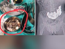 शख्स ने निगले इतने सिक्के, दर्द से फूल गया पेट तो सर्जरी कर निकालना पड़ा बाहर