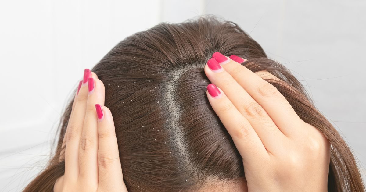 Trending news: Take special care of hair like this in winter, adopt home remedies for dandruff free hair - Hindustan News Hub Trending news: Take special care of hair like this in winter, adopt home remedies for dandruff free hair - Hindustan News Hub